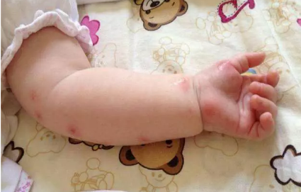 孕妇和宝宝为什么容易招蚊子 宝宝被蚊子咬了怎么办