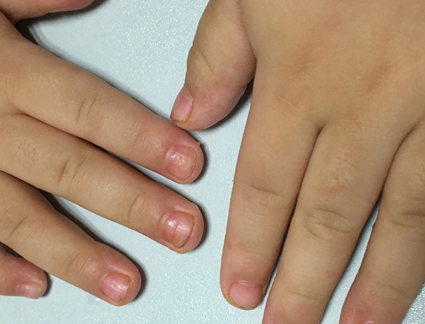 宝宝指甲凹凸不平是什么原因 宝宝指甲凹凸不平怎么办