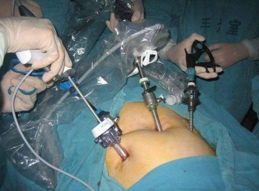 腹腔镜手术会影响怀孕吗 腹腔镜术后注意事项