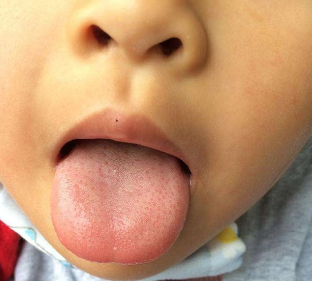 宝宝地图舌能自愈吗 地图舌是什么样子的