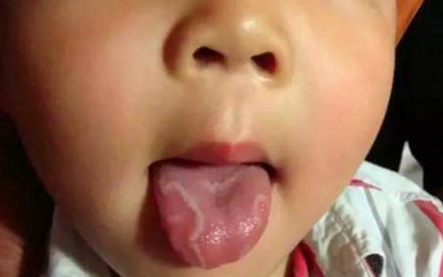 宝宝地图舌要做哪些检查 宝宝长地图舌有什么危害