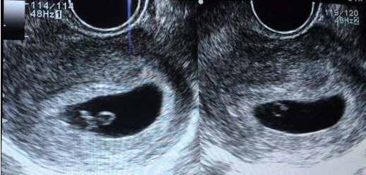 孕囊形状可以看出宝宝的性别吗 通过孕囊能看出怀了几个宝宝吗