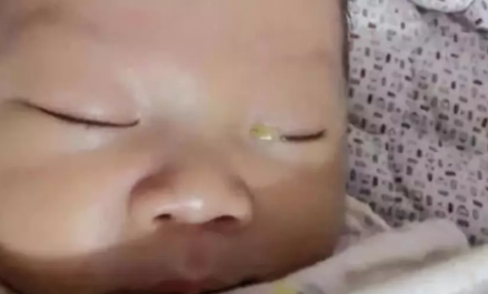 宝宝先天性泪囊炎有哪些治疗方法 宝宝先天性泪囊炎怎么保守治疗
