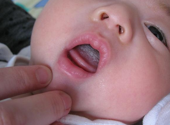 宝宝口腔溃疡怎么办好 宝宝溃疡怎么护理