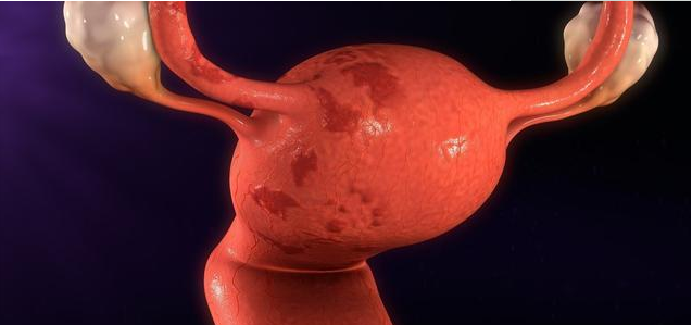 子宫内膜炎可以过性生活吗 如何确诊子宫内膜炎