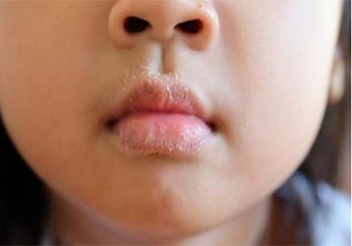 孩子嘴唇干裂是为什么 孩子嘴唇干裂怎么办