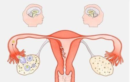 什么是纵隔子宫 纵隔子宫会导致女性长期不孕吗