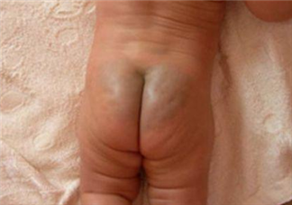 宝宝屁股上的淤青是什么 关于宝宝屁股上淤青的迷信说法