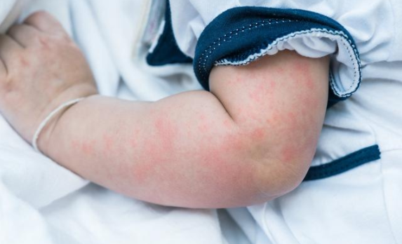 荨麻疹能根治吗 孩子得了荨麻疹如何治疗护理
