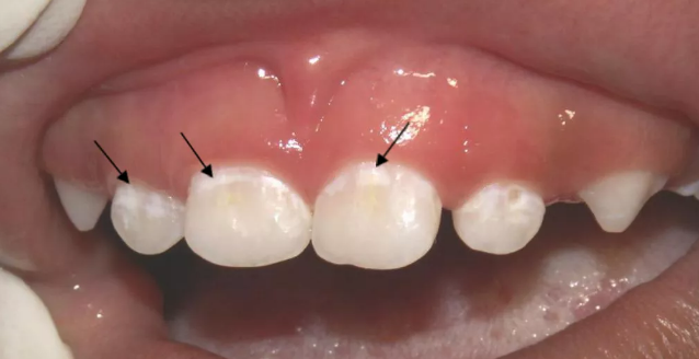 孩子的牙齿出现小白点是怎么回事 什么原因导致孩子牙齿出现小白点