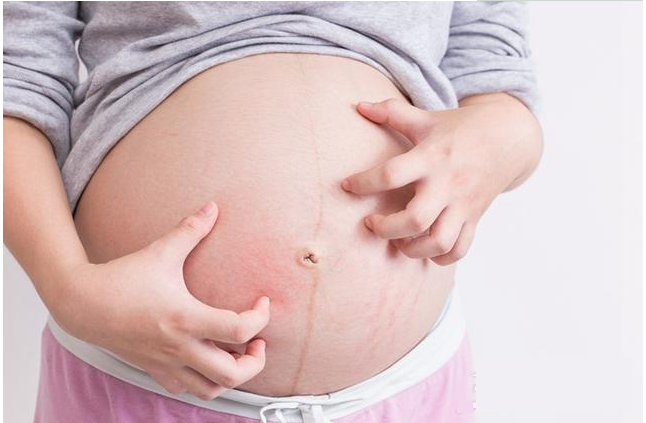 孕期容易出现什么皮肤问题 孕期常见的几大皮肤问题