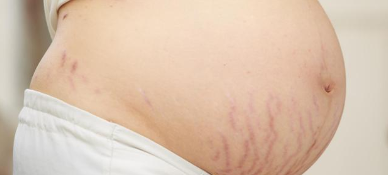 肚子长妊娠纹的4个信号 妊娠纹主要都长在什么地方