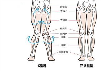 孩子x型腿和什么有关 孩子x型腿需要治疗吗