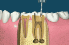 牙医生说的杀神经是什么意思 什么情况下需要杀神经