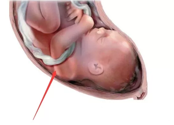 孩子|出现脐带绕颈会影响分娩吗 脐带绕颈的影响大不大