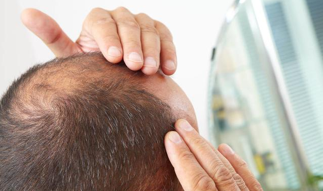 中年脱发|一到中年为什么容易脱发 中年男性秃头怎么办