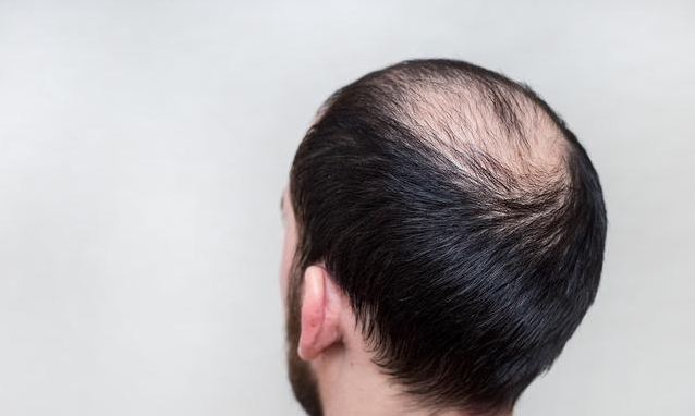 一到中年为什么容易脱发 中年男性秃头怎么办