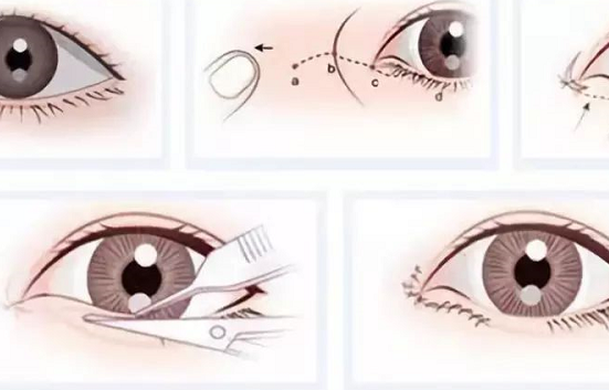 开眼角多久能恢复好 开眼角眼睛真的能变大吗