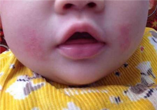 为什么宝宝会得口水疹 宝宝口水疹的护理及预防方法