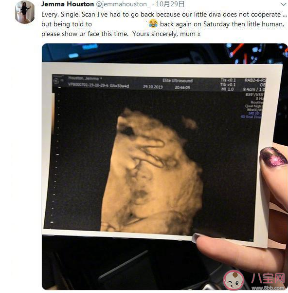 孕检时宝宝在肚子里比v是怎么回事 胎儿真的是在比手势v吗