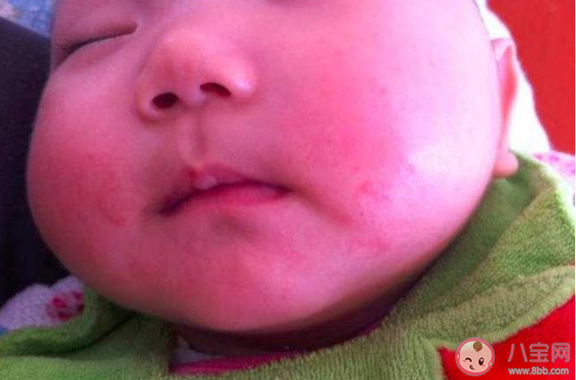 为什么宝宝会得口水疹 宝宝口水疹的护理及预防方法