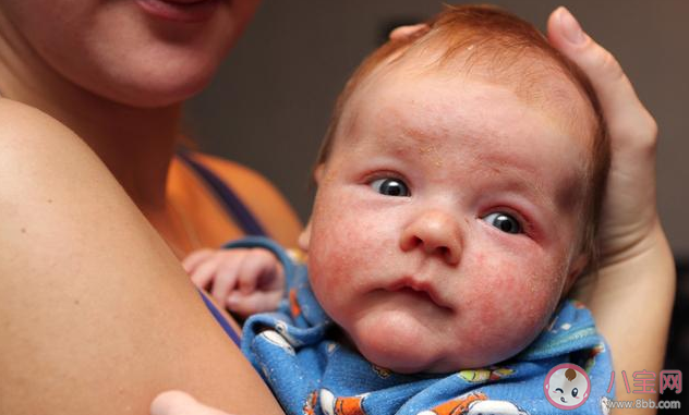 宝宝得湿疹会留疤吗|宝宝得湿疹会留疤吗 小孩脸上有湿疹怎么护理