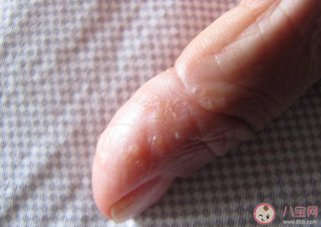 手指脱皮是缺钙吗 为什么冬季手指容易脱皮