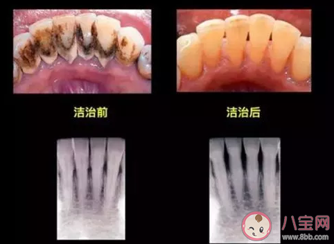 牙结石对牙齿会有什么影响 每天刷牙为什么还会长牙结石