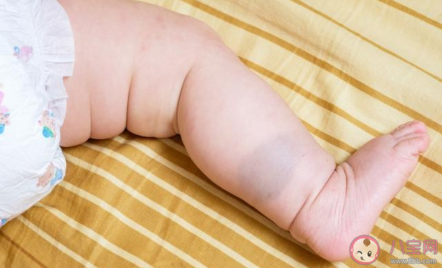 宝宝长胎记需要处理吗 为什么宝宝会长胎记