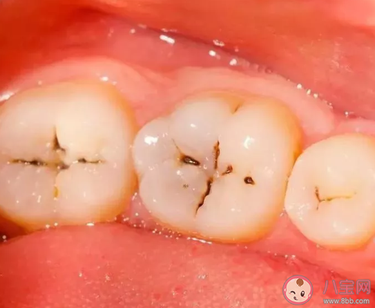 孩子牙隐裂怎么办 吃坚果会造成牙隐裂吗