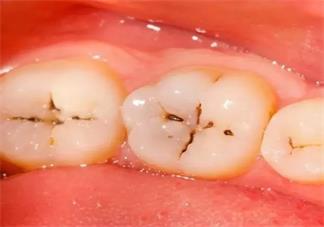 孩子牙隐裂怎么办 吃坚果会造成牙隐裂吗