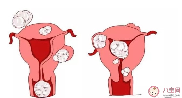 子宫肌瘤有什么特征 女性得了子宫肌瘤怎么样