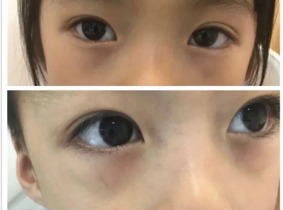 孩子黑眼圈严重怎么回事 黑眼圈眼袋很重怎么办