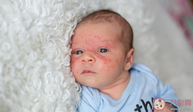 宝宝湿疹治疗护理怎么做比较好 湿疹有方法能避免吗