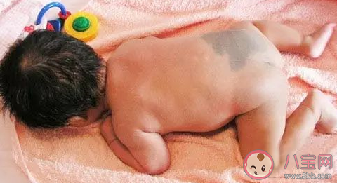 婴儿胎记几岁可以去除  婴儿头皮上有胎记可以去除吗