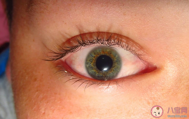 早上起来眼睛肿肿的是怎么回事 怎样才能消除肿泡眼