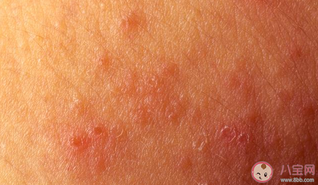 长湿疹是因为湿气重吗 为什么夏季湿疹容易加重
