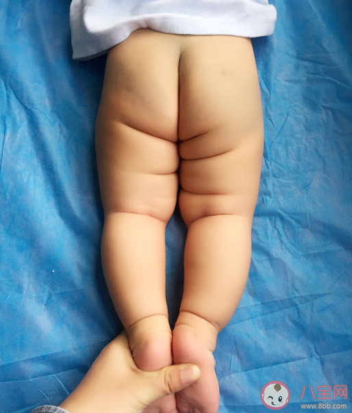 宝宝臀纹不对称一定是有问题吗 臀纹不对称是不是髋关节发育不良