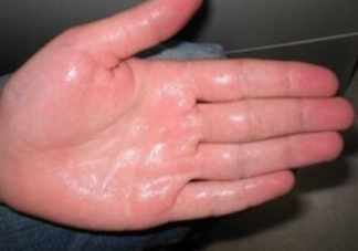 手汗症有要怎么治疗好 手汗症能用中医调理吗