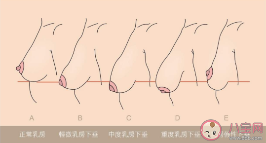 真正的乳房下垂是什么样的 怎么区分真正的乳房下垂