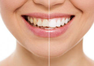 想让牙齿变白有什么好用的方法 不同牙齿增白方法效果