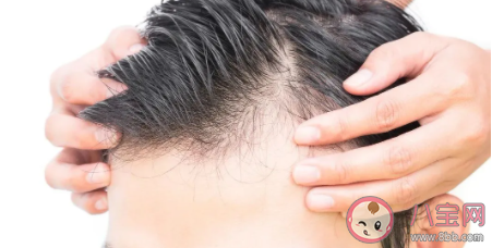专家教你如何自测脱发程度 辨别脱发是生理性还是病理性
