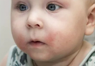 宝宝的脸上有一团团白色的东西是什么 儿童白色糠疹怎么治疗最有效