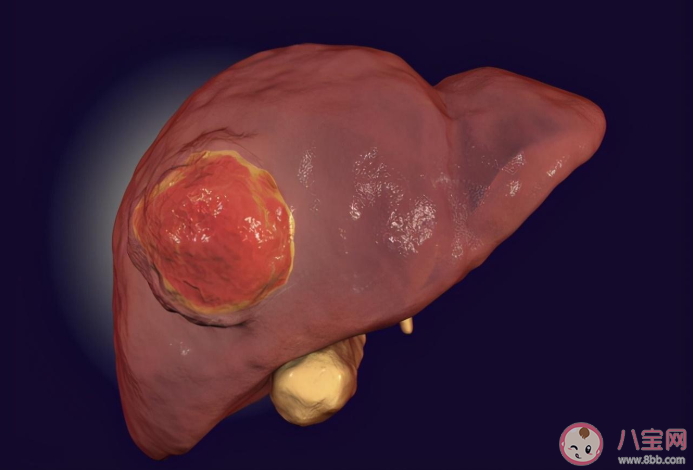 为什么肝癌一发现就是晚期 如何保护好肝脏