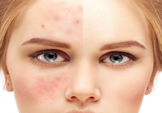哪些皮肤问题可以刷酸 具体刷酸方法是什么