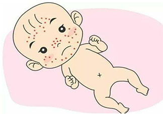 怎样鉴别新生儿面疱和湿疹 面疱和湿疹具体区别是什么