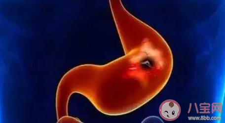 胃癌高危人群有哪些 科学预防胃癌的方法
