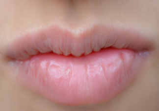 舔嘴唇会让嘴唇更干吗 怎么判断是唇部干燥还是唇炎