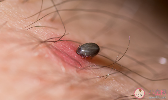 被蜱虫叮咬就有致命危险吗 被蜱虫咬伤后有什么症状表现