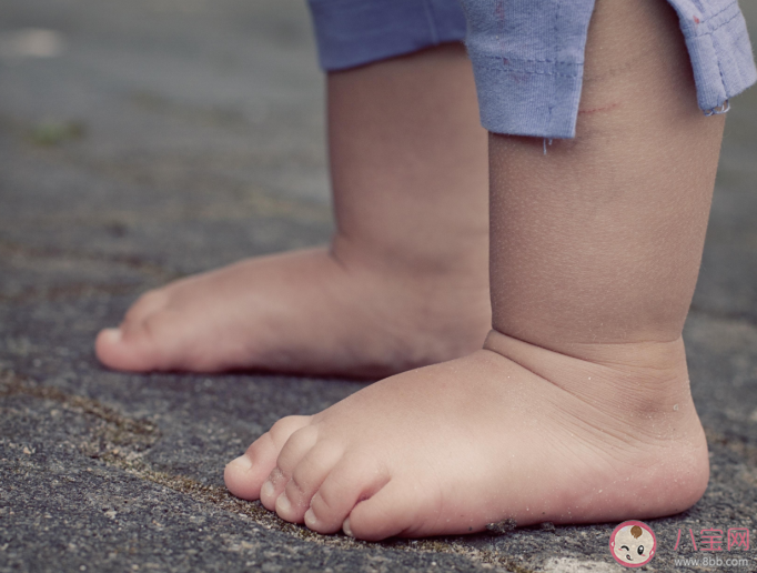 足外翻对孩子有什么影响 如何预防宝宝足外翻